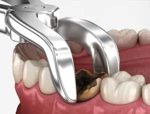 إزالة ضرس العقل