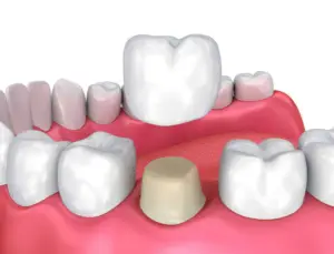 تاج وجسر الأسنان