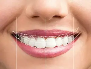 تصميم ابتسامة هوليوود