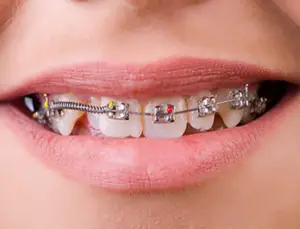 تقويم الأسنان الشفاف إنفيزالاين