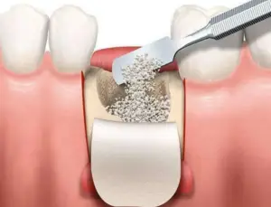 حشو وترقيع عظام الأسنان