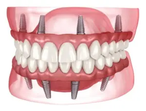 زراعة الأسنان الفم الكامل