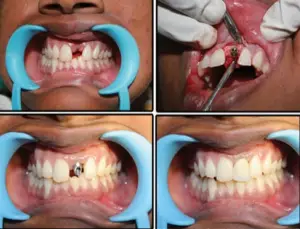 زراعة الأسنان في الهند