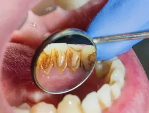 علاج أمراض اللثة