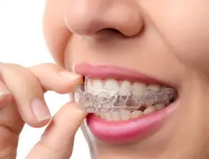 علاج الأقواس الخفية