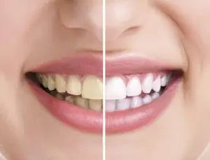 علاج تبييض الاسنان