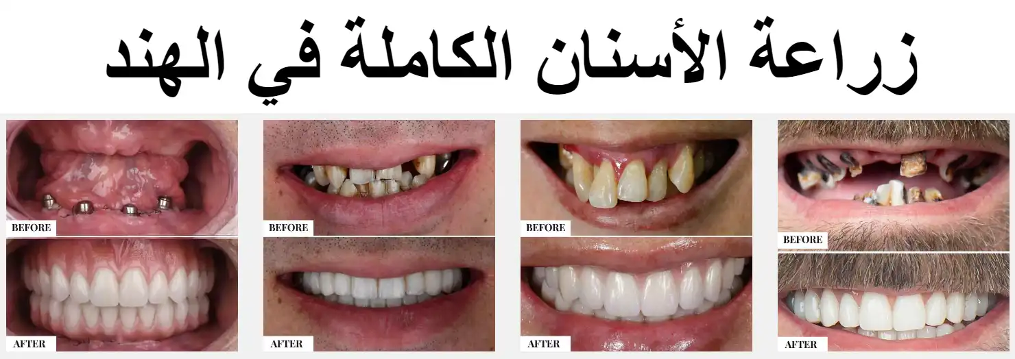 Full Mouth Dental Implants in India