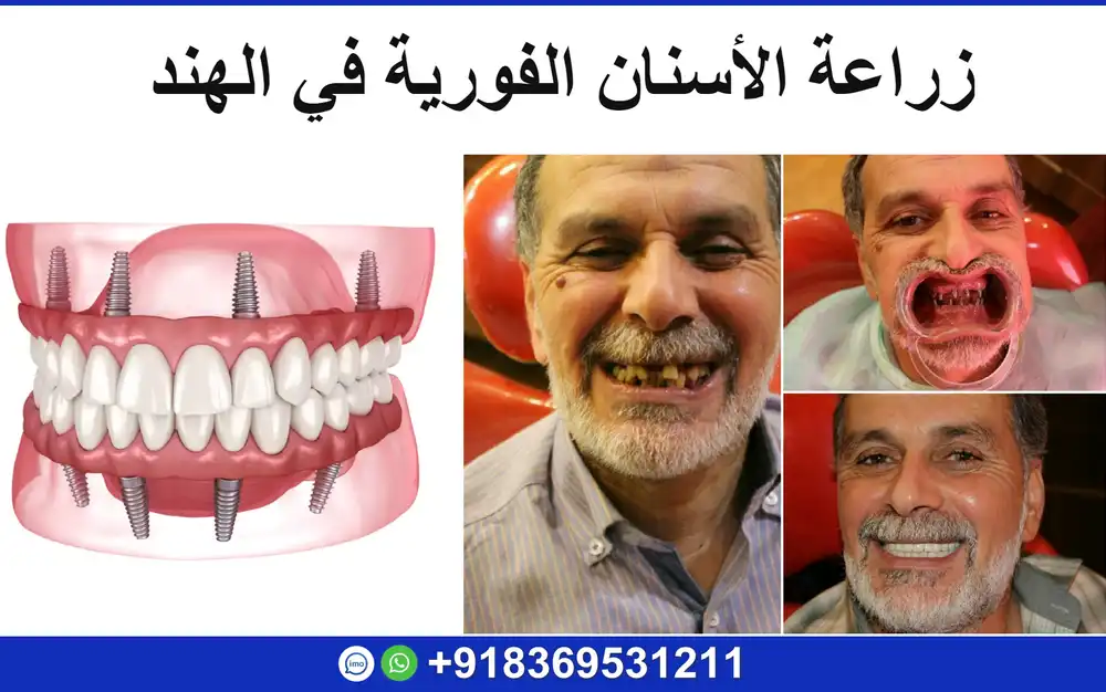 زراعة الأسنان الفورية في الهند