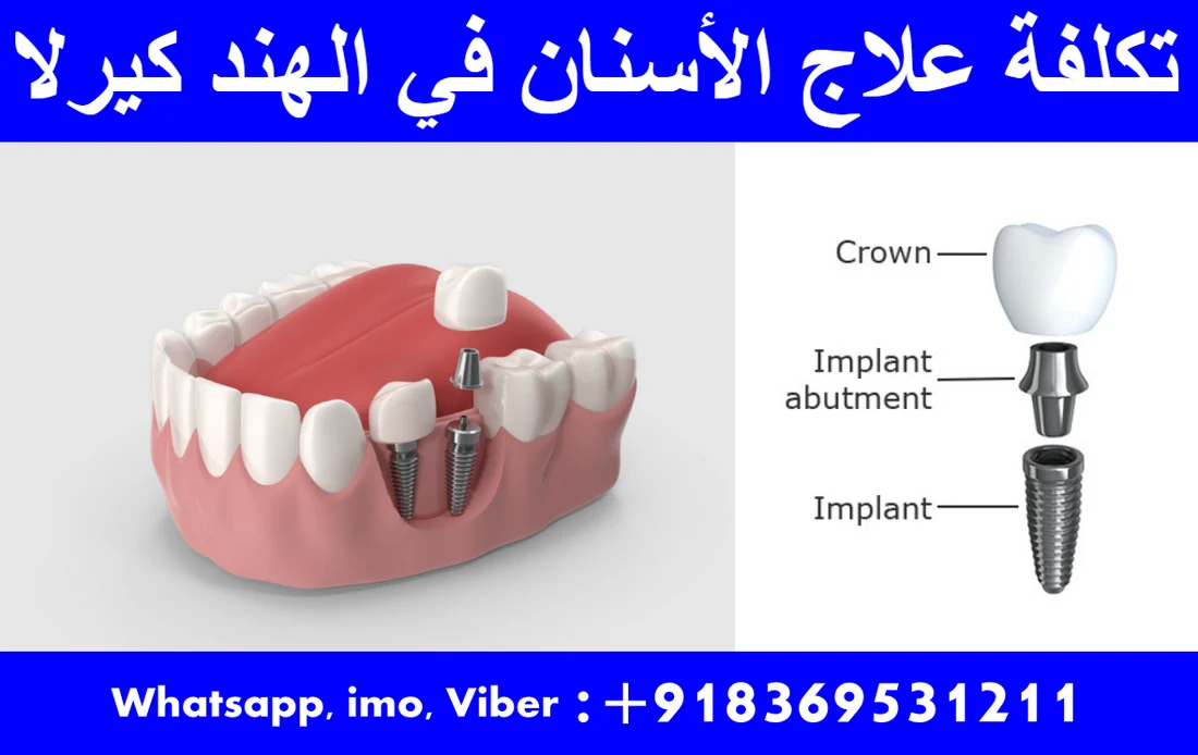 تكلفة علاج الأسنان في الهند كيرلا