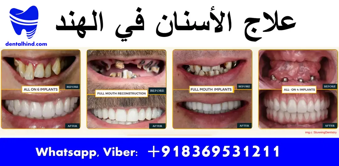 علاج الأسنان في الهند