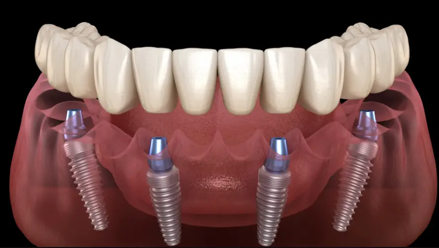 all on 4 dental implants