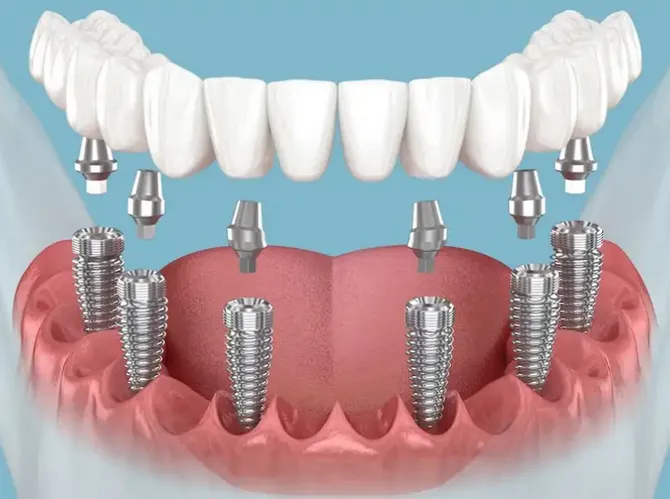 all on 6 dental implants