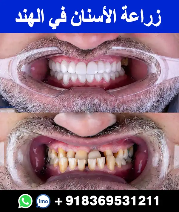 زراعة-الأسنان-في-الهند