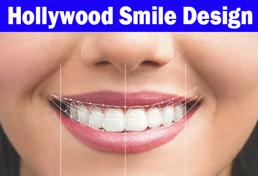 Hollywood-Smile-Design-in-India---DentalHind