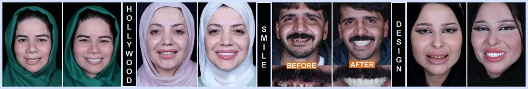 Hollywood Smile India Hollywood Smile India