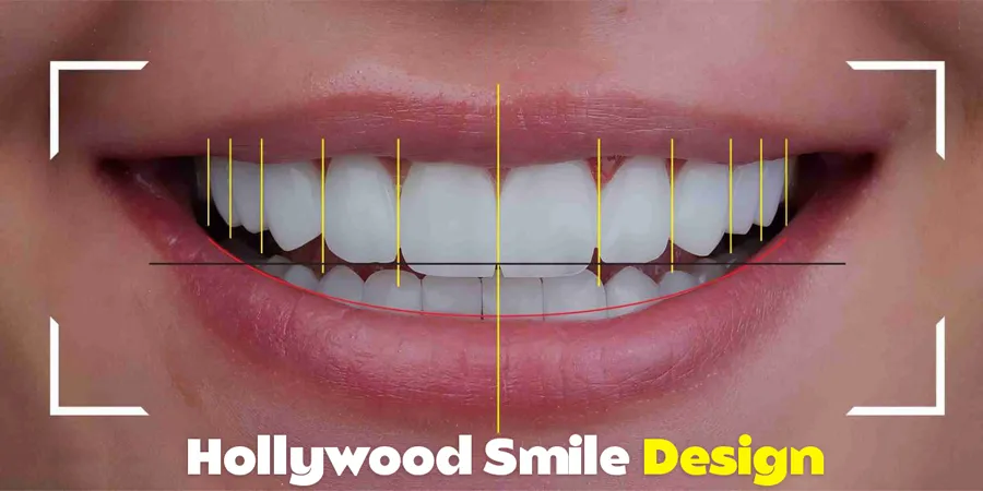 Hollywood-Smile-Makeovers Hollywood-Smile-Makeovers