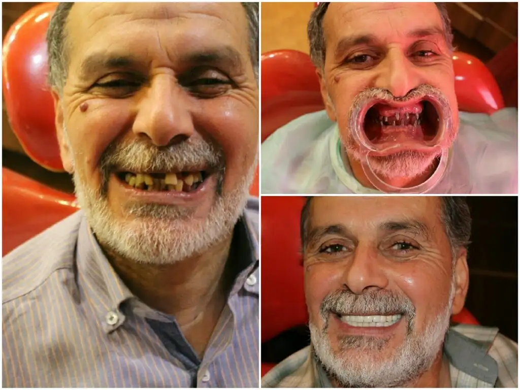 Immediate Loading Dental Implants (Single visit) Immediate Loading Dental Implants (Single visit)