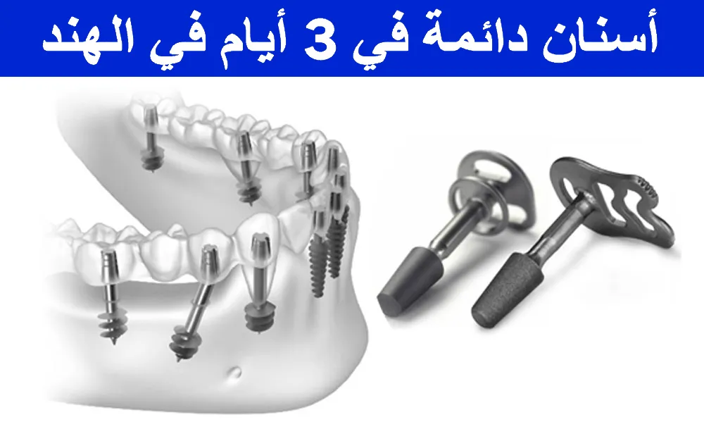 Permanent-Teeth-in-3-days Permanent-Teeth-in-3-days