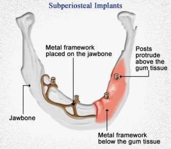 Subperiosteal Implants Subperiosteal Implants