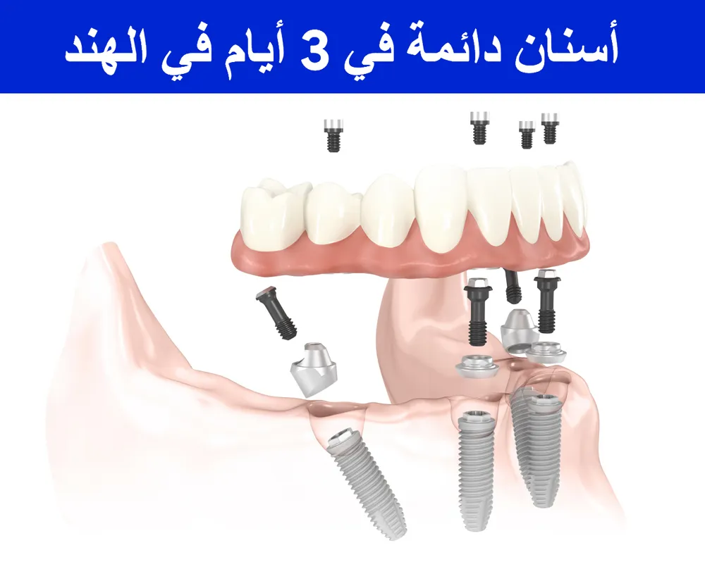 أسنان-دائمة-في-3-أيام-في-الهند أسنان-دائمة-في-3-أيام-في-الهند